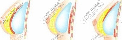 新疆青松星范医疗隆胸图