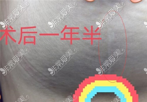 杭州美莱缩胸手术术后疤痕图