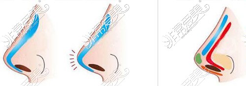 扬州施尔美整形医院隆鼻示意图