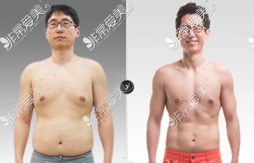 韩国365mc男性女乳症吸脂对比
