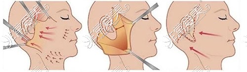 面部除皺抗衰拉皮示意圖