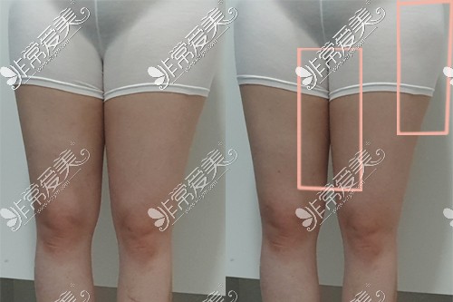 韩国365mc医院大腿吸脂手术前