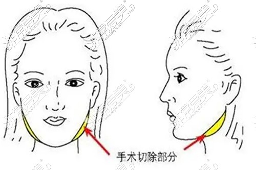 厦门哪里可以磨下颌骨?磨骨哪家医院好?看网友推荐!