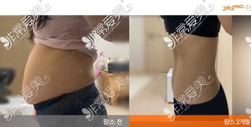韩国365mc抽脂亲身经历分享!大腿吸脂/腰腹吸脂后她们这样说