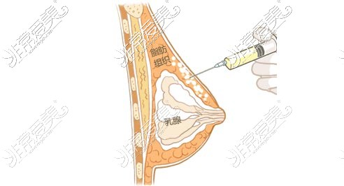 注射玻尿酸丰胸示意图