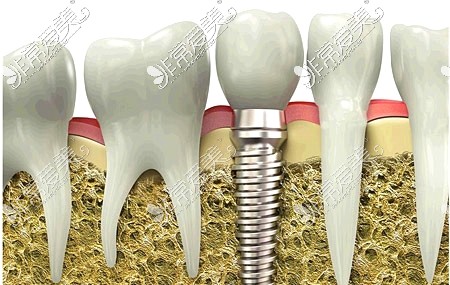 昌吉种植牙示意图
