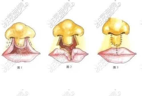 杭州哪里做唇裂修复比较好？这3唇裂修复比较好还不贵