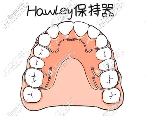 牙齿矫正保持器示意图