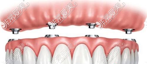 半口半固定种植牙示意图