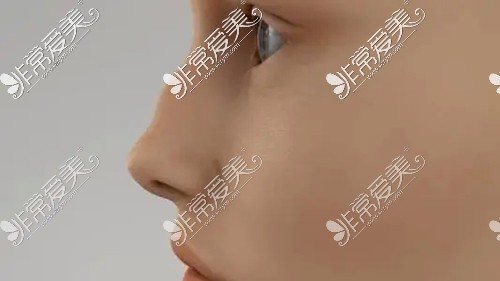 驼峰鼻矫正手术多少钱?韩国4月31日驼峰鼻整形不贵审美还好!