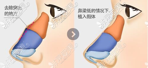驼峰鼻矫正手术多少钱?韩国4月31日驼峰鼻整形不贵审美还好!
