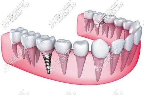 种植牙示意图