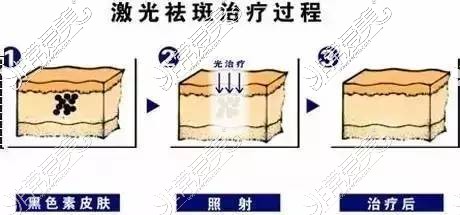 激光祛斑示意图