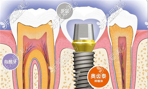 宿州种植牙多少钱一颗 这份正规牙科优惠价目表要知道