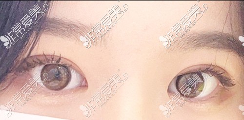 韩国自然粘连法双眼皮术后图