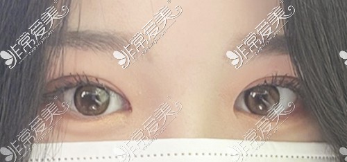 韩国自然双眼皮术后美照