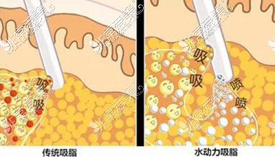 广州新抽脂技术是哪种？成熟吗？哪种改善结果好口碑佳？