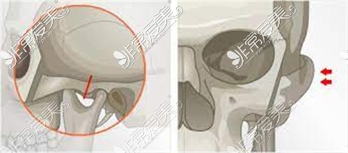 颧骨整形示意图