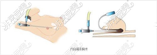 内窥镜丰胸手术示意图