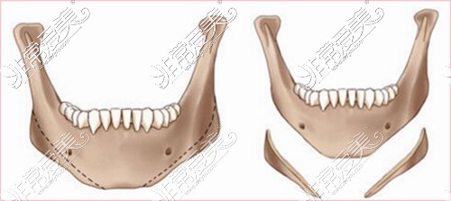 下頜角手術(shù)截骨示意圖