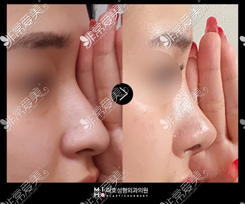 韩国MIHO整形外科鼻中隔+耳软骨+驼峰鼻手术