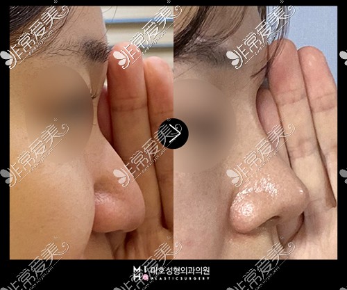 韩国美好MIHO整形外科驼峰鼻手术