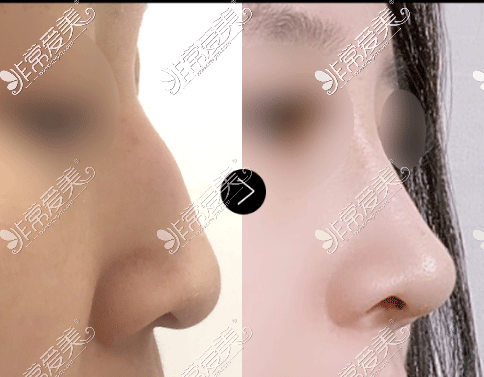 韩国MIHO整形医院鼻子矫正前后图
