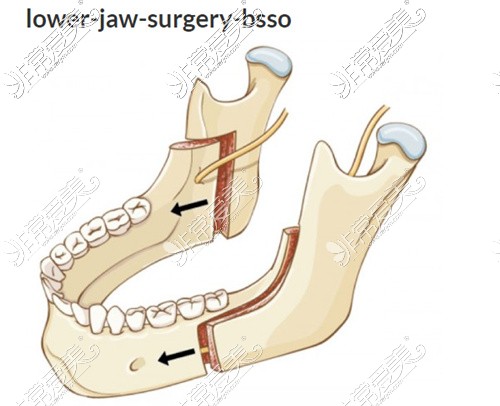 正颌手术下颌截骨BSSO术式
