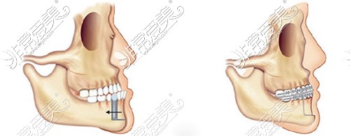 正颌手术下颌截骨Kole术式