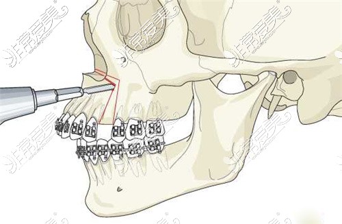 上颌前部切骨手术Wassmund术式