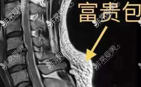 富贵包需要去医院治吗？医院治疗抽脂好还是切除好！