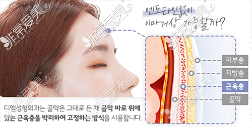 韩国迪美整形额头提升做得如何 实例探索迪美额头提升术
