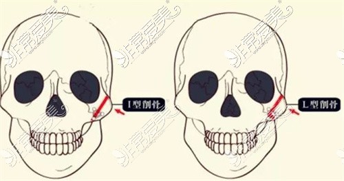 成都友谊医院颧骨对比图