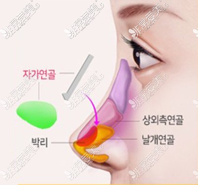 韩国隆鼻整形