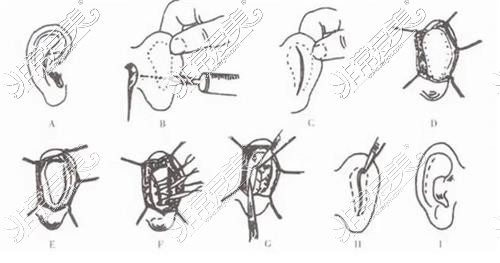耳朵矫正示意图