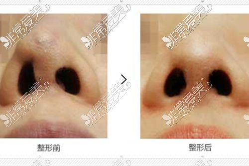 关注韩国WJ原辰鼻部整形实时动态,好多人慕名过来做鼻修复!