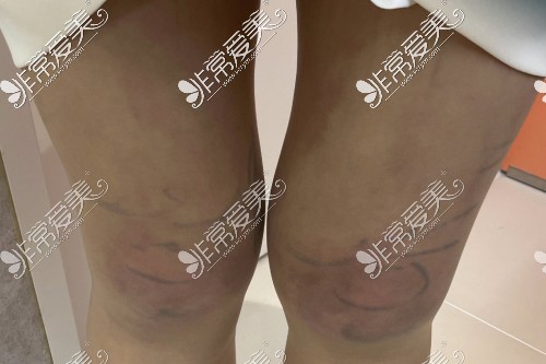 大腿吸脂手术多久可以恢复？韩国Qine医院大腿吸脂第二天！