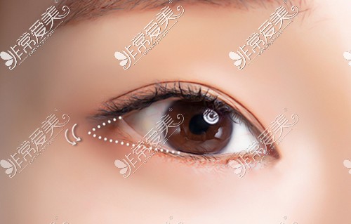 韩国迪美李柱洪院长眼整形解析 眼肌矫正bbang开眼角是特色