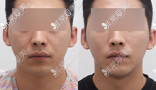 韩国JUST整形外科男士面部提拉+填充手术