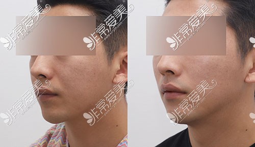 韩国JUST整形外科男士面部提拉+填充手术
