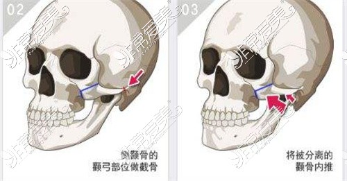 磨骨手术示意图