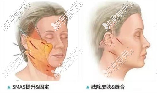 面部提升固定和缝合后