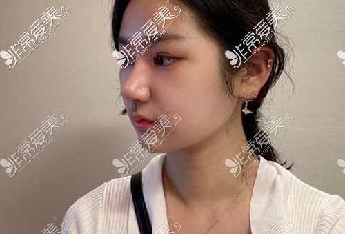 韩国的迪美眼+鼻+面部吸脂术后侧面
