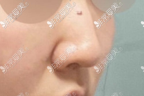韩国整鼻子出名的医院！VG百利酷整形外科鼻部手术分享！