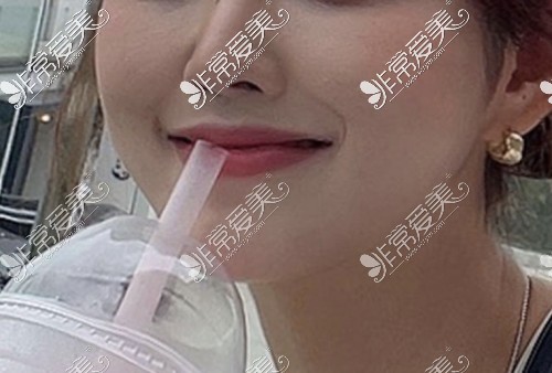 韩国VG百利酷鼻子面部轮廓整形手术后分享