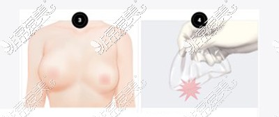 隆胸假体破裂胸部上下不对称