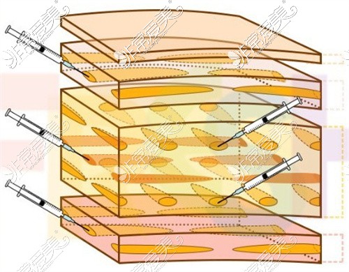 不同层次的面部脂肪填充