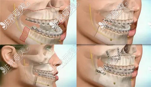 正颌手术示意图