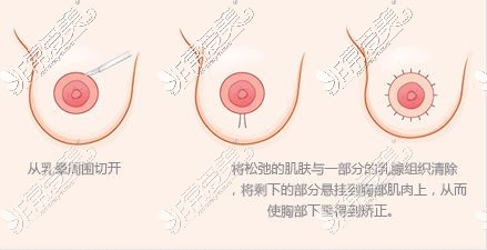 胸部下垂该怎么办?看了韩国WJ原辰的提胸手术都说变化大!