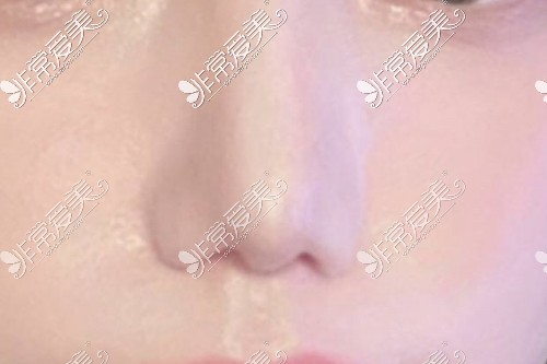 蒜头鼻子鼻部整形全过程！韩国VG百利酷鼻修复手术分享！
